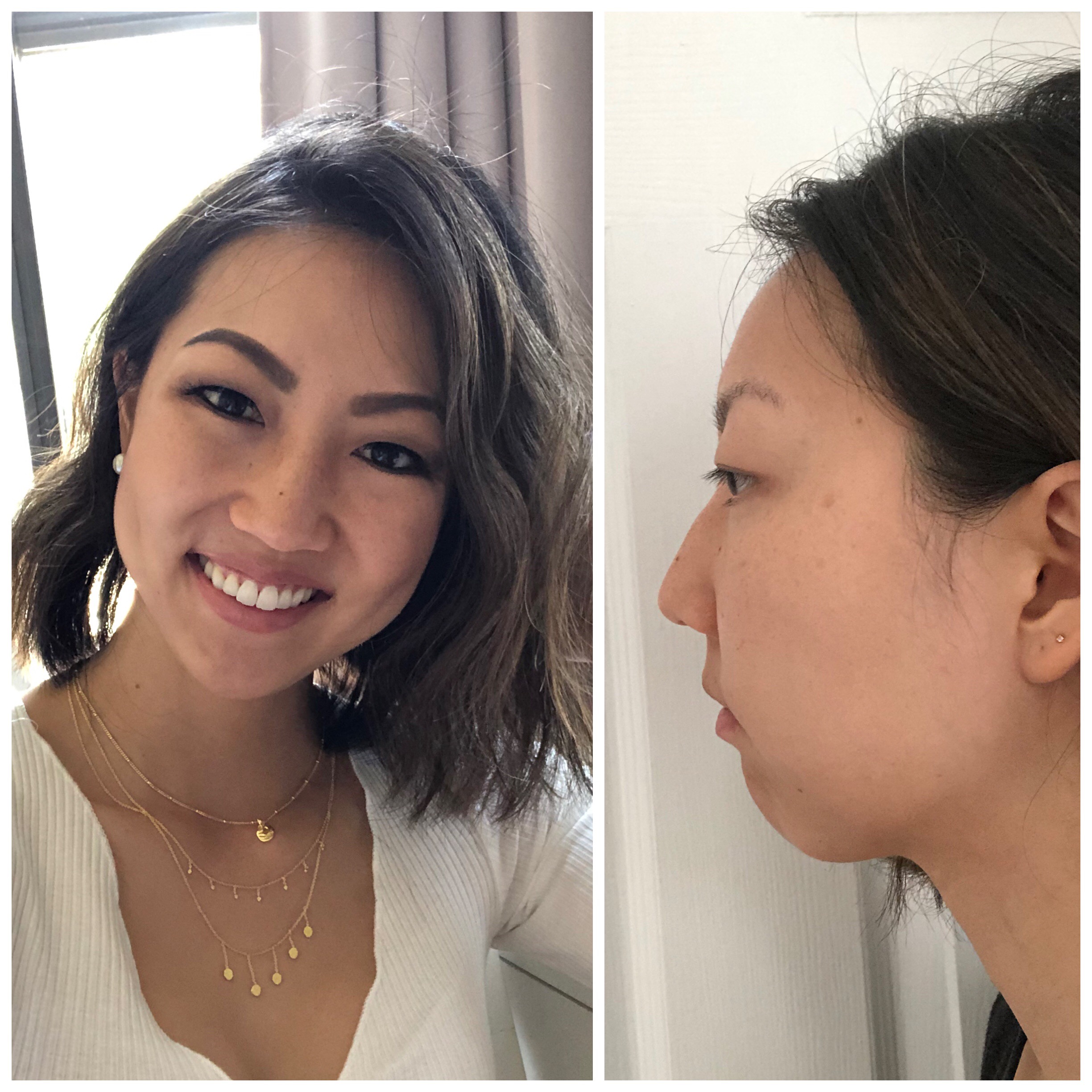 My Experience Getting Kybella – TREND ENVY